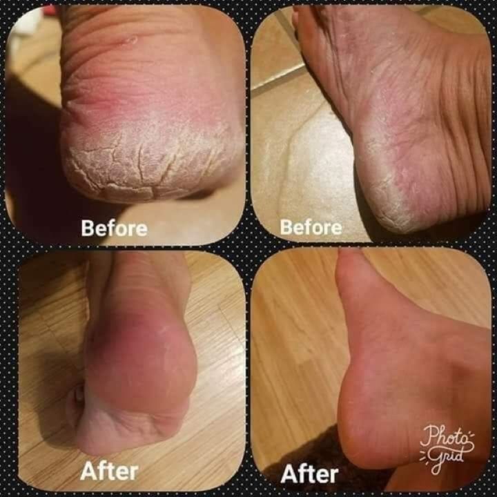 FOOT REPAIR CREAM-Cream for Dry Cracked Feet, Athletes Foot, Nail Fungus, Jock Itch, Ringworm, Cracked Heels and Itchy Skin – Pain Relieving Foot Cream - Organic Hair Solution, LLC