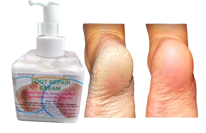 FOOT REPAIR CREAM-Cream for Dry Cracked Feet, Athletes Foot, Nail Fungus, Jock Itch, Ringworm, Cracked Heels and Itchy Skin – Pain Relieving Foot Cream - Organic Hair Solution, LLC