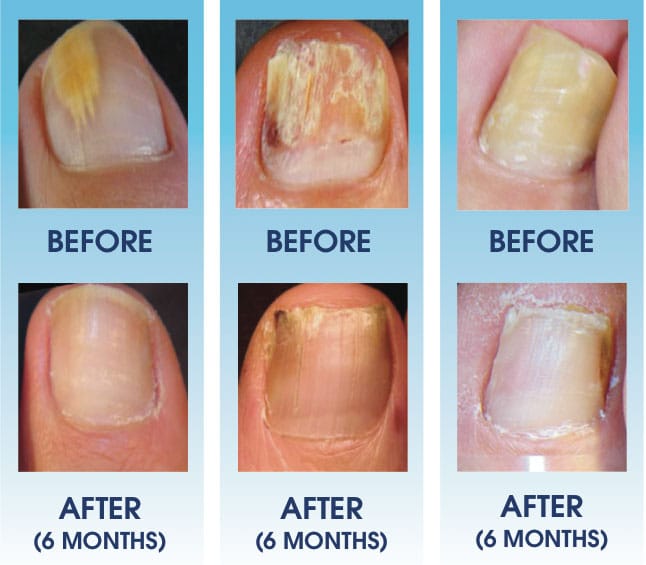 Organic Toenail Fungus Treatment Extra Strength - nail repair, toenail softener yellow toenail treatment, ingrown nail and foot fungus treatment extra strength - Organic Hair Solution, LLC